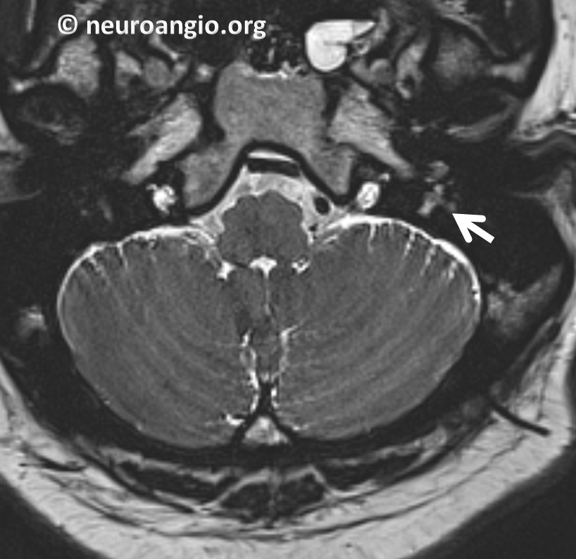 Pulsatile Tinnitus Glomus Tympanicum